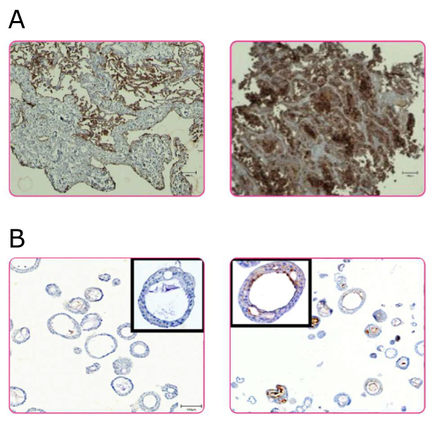 Organoid model selection Four images of the immunohistochemistry of normal and tumor patient tissues and patient-derived organoids.