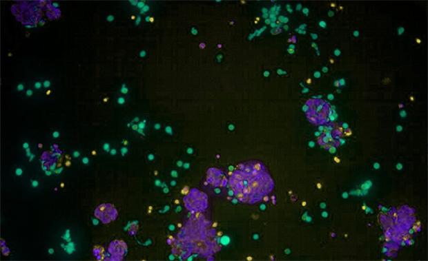 IBD PDO Co-Culture Fluorescent microscopy image of IBD PDO co-cultures.
