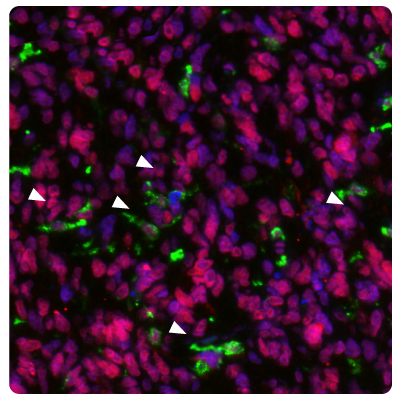 Image of IHC-IF staining of glioblastoma samples using Anti-HLA-DRA monoclonal and Anti-METTL21B polyclonal (Product No. HPA043020) antibodies showing HLA-DRA positive activated microglia.