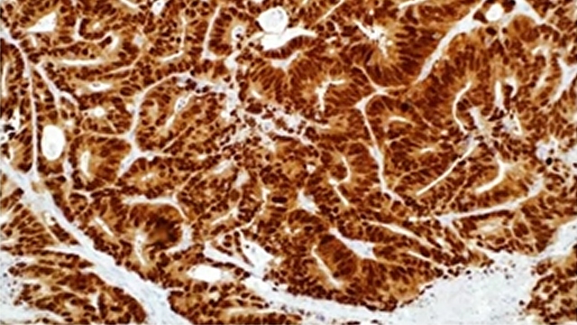 Colorectal Cancer and Immunohistochemistry Webinar Colorectal Cancer and Immunohistochemistry Webinar