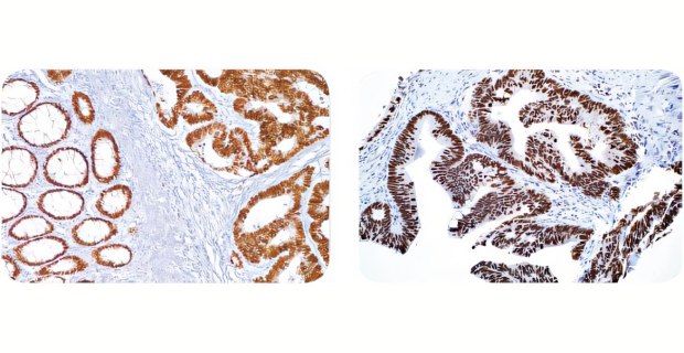 Diagnostic immunohistochemical staining Tinción del carcinoma de colon con anticuerpos para DIV Cell Marque™