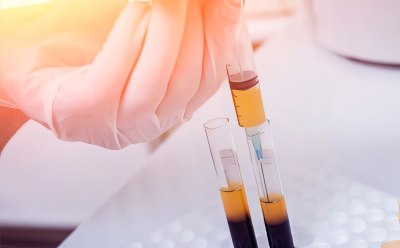 Faster production of blood plasma products Imagen que representa un entorno de laboratorio donde una persona, que lleva guantes, está manipulando con sumo cuidado tubos de ensayo llenos de un líquido amarillento. Esta escena refleja la meticulosidad y la precisión implicadas en la realización de un experimento científico. La imagen se asocia a menudo con temas como el fraccionamiento del plasma sanguíneo, el tratamiento con PRP (plasma rico en plaquetas) y la investigación científica en salud y longevidad.