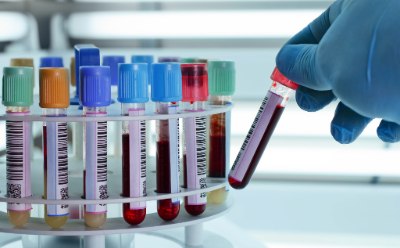 Blood samples fill a test tube rack A gloved hand places a test tube holding a blood sample into a plastic laboratory test tube rack holding other blood samples with various colored lids