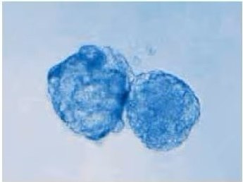 MCF-7 breast cancer cells Tumorsphere culture of breast cancer cells MCF-7