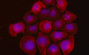 UFH-001 Human Triple Negative Breast Cancer Cells Tinción fluorescente de las células de cáncer de mama humano UFH-001