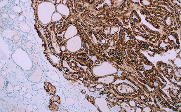 IHC staining of clinical tissue with a Cell Marque™ TROP2 antibody Tinción IHC de carcinoma papilar tiroideo con anticuerpo TROP2 (EP431) Cell Marque™ y contratinción