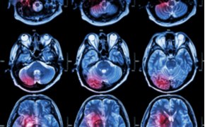 Im&aacute;genes metab&oacute;licas con hiperpolarizaci&oacute;n