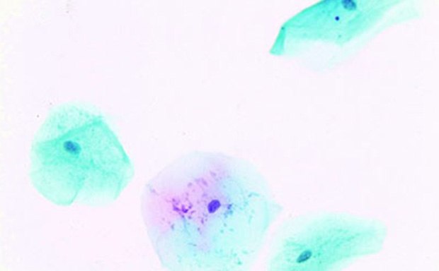Papanicolaou staining of vaginal sample Tinción de Papanicolaou de una muestra de secreción vaginal que muestra la gama característica de coloración nuclear y citoplasmática de las células exfoliativas