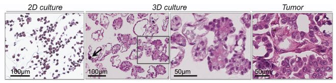 OAW42 epithelial ovarian cancer cells grown in 2D and 3D, the later of which resembles the well-differentiated (Grade 1) serous ovarian tumor shown on the far right. The 3D culture even contains a psammoma body (arrow), a calcified circular structure found in some tumors. Image adapted from (Myungjin Lee et al., 2013). epithelial ovarian cancer cells