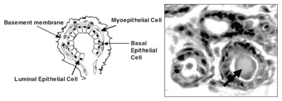 Diagram of a mammary acinus on left and a morphologically similar 3D culture derived MCF-10A acinus on right. The lumens of the in vitro derived acini even contain secreted material on the inside (arrow). Image adapted from Debnath et al., 2003. Diagram of a mammary acinus on left and a morphologically