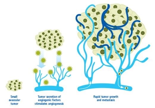 Tumors can stimulate nearby normal cells to produce angiogenesis signaling molecules resulting in new blood vessels formation. These new vessels in turn supply growing tumors with oxygen and nutrients, allowing the cancer cells to invade nearby tissue, to move throughout the body, and to form new colonies of cancer cells, called metastases. Angiogenesis in Cancer