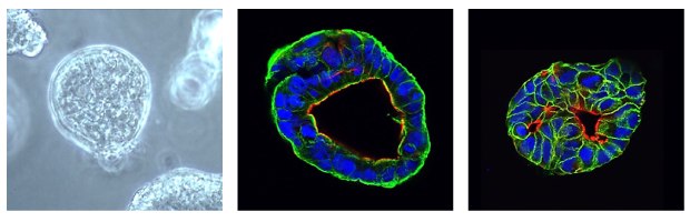 Microscopy images of PDAC organoids. The first image is a contrast microscopy image of the organoid, with one large clear organoid in the center of a grey background. The second image is an immunocytochemical stain of the organoid. CK19 surrounds the cells in the organoid and is shown in green, actin lines the inner ring of the cells of the organoid and is shown in red, and DAPI forms small circles in the middle of the cells and is shown in blue. The third image is an immunocytochemical stain of the organoid; EpCAM lines each cell in the organoid and is shown in green, actin lines the inner ring of the cells of the organoid and is shown in red, and DAPI forms small circles in the middle of the cells and is shown in blue. 