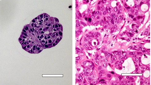 Lung cancer organoid cultured in 3D vs. native tissue Histological and morphological comparison of acinar/papillary 3dGro™ human lung organoids
