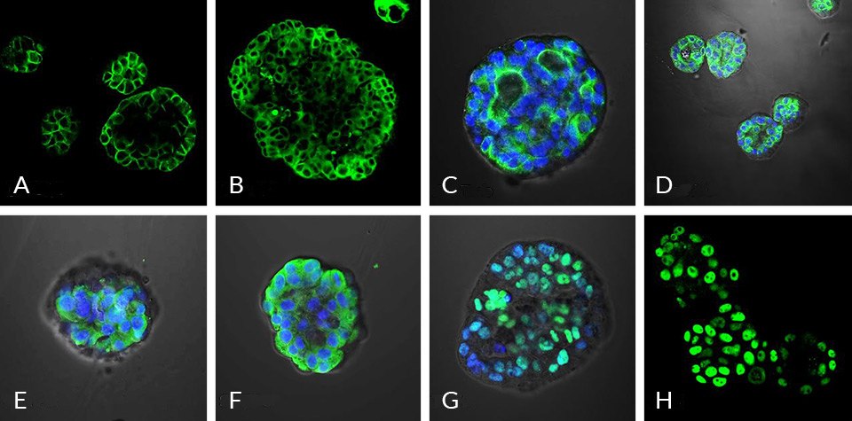 Immunocytochemical characterization of human lung organoids Microscopy image of lung cancer organoids displaying major epithelial markers