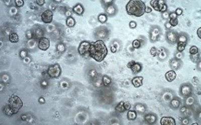 Solid lung pdo 3D culture of lung cancer pdo derived from adenocarcinoma solid lung tumor biopsy