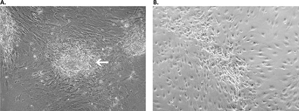 primary-cancer-culture-system Primary culture derived from an invasive adenocarcinoma with the Primary Cancer Culture System