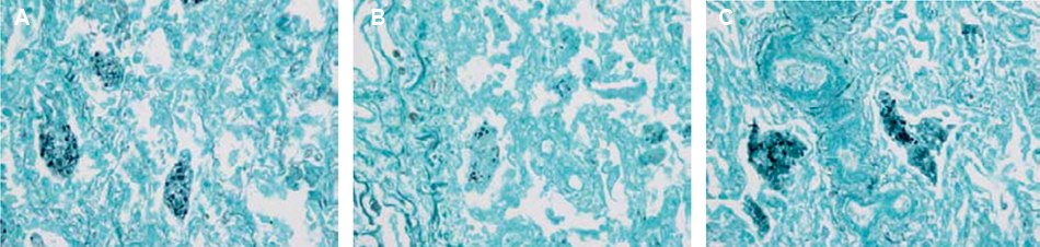 Impact of water sources on GMS staining of P. jirovecii infected lung tissue Micrographs GMS-stained <i>Pneumocystis jirovecii</i> infected lung tissue