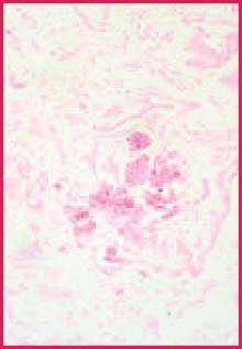 Positive fungus control A close-up view of a pinkish cellular structure positive fungus control. chromic acid-Schiff stain, 400X