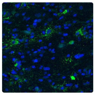 Immunostaining Astrocytoma with Anti- CHI3L1 Antibody Immunostaining with fluorescence immunohistochemistry of astrocytoma samples stained with the Anti-CHI3L1 antibody (Product No. AMAb91777) showing strong protein expression in astrocytoma.