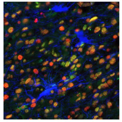 EZH2, PARP1, and ALDH1A3 Expression in Astrocytoma Multiplexed IHC-IF staining of astrocytoma using Anti-EZH2 monoclonal (Product No. AMAb91752), Anti-PARP1 monoclonal (Product No. AMAb90959), and Anti-ALDH1A3 monoclonal (Product No. AMAb91754) antibodies.