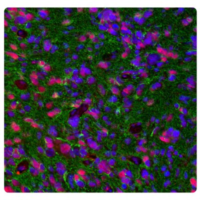 ATRX and GFAP Immunoreactivity in Glioblastoma Multiplexed IHC-IF staining of glioblastoma showing ATRX and GFAP immunoreactivity in tumor cells. Anti-ATRX antibody (Product No. AMAB90784) and Anti-GFAP antibody (Product No. AMAB91033) were used.