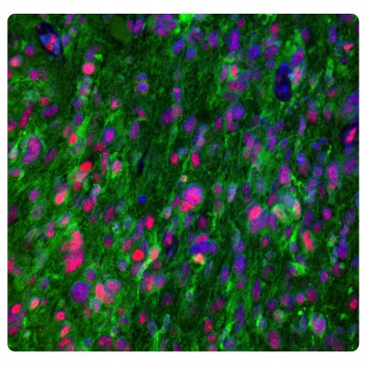 ATRX and IDH1 Immunoreactivity in Glioblastoma Multiplexed IHC-IF staining of glioblastoma showing ATRX and IDH1 immunoreactivity in tumor cells. Anti-ATRX antibody (Product No. HPA001906) and Anti-IDH1 antibody (Product No. AMAB90578) were used.