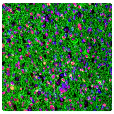 ATRX and GFAP Immunoreactivity in Astrocytoma Multiplexed IHC-IF staining of astrocytoma showing ATRX and GFAP immunoreactivity in tumor cells. Anti-ATRX antibody (Product No. AMAB90784) and Anti-GFAP antibody (Product No. AMAB91033) were used.