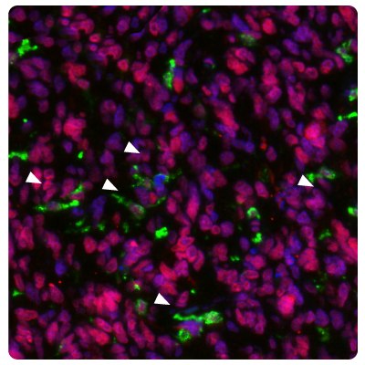 METTL21B Expression in Glioblastoma Tumor Cells Image of IHC-IF staining of glioblastoma samples using Anti-HLA-DRA monoclonal and Anti-METTL21B polyclonal (Product No. HPA043020) antibodies showing HLA-DRA positive activated microglia.