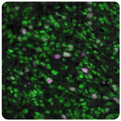 EZH2 and SGO2 Expression in Glioblastoma Multiplexed IHC-IF staining of glioblastoma samples using Anti-EZH2 monoclonal (Product No. AMAb91750) and Anti-SGO2 polyclonal (Product No. HPA035163) antibodies.