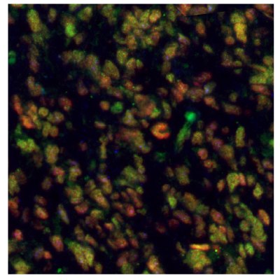 EZH2, PARP1, and ALDH1A3 Expression in Human Glioblastoma Multiplexed IHC-IF staining of glioblastoma using Anti-EZH2 monoclonal (Product No. AMAb91752), Anti-PARP1 monoclonal (Product No. AMAb90959), and Anti-ALDH1A3 monoclonal (Product No. AMAb91754) antibodies.