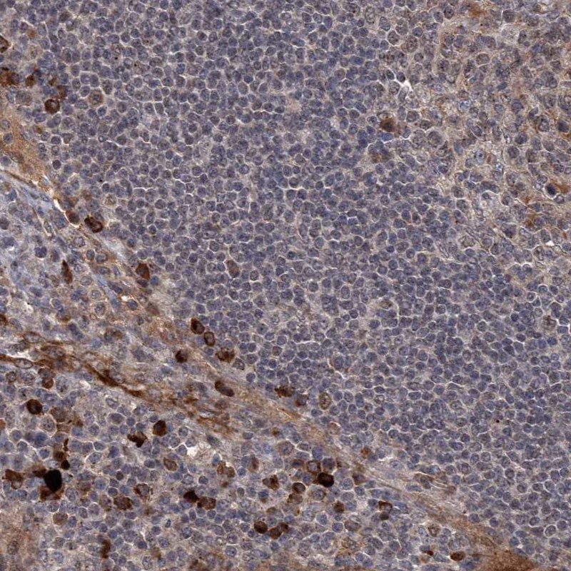 Anti-GPR132 Antibody Immunohistochemical staining of a human colon with adenocarcinoma. The anti-GPR132 antibody (Cat. No. HPA029695) binding is visible in brown.