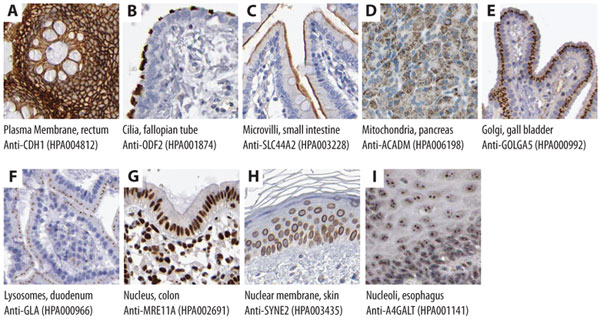 ihc-stainings-subcellular-localization Immunohistochemical Stainings Showing Subcellular Localization
