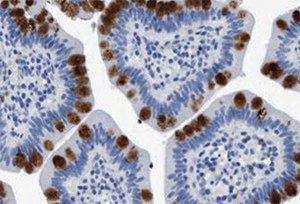 Immunohistochemistry. Anti-HABP2: Cat. No. HPA019518: Immunoperoxidase staining of formalin-fixed, paraffin-embedded human small intestine shows strong intracellular proteinaceous material positivity in glandular cells. Immunoperoxidase staining of formalin-fixed, paraffin-embedded human small intestine shows strong intracellular proteinaceous material positivity in glandular cells
