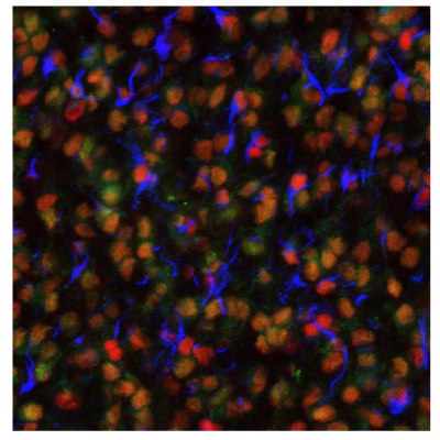 EZH2, PARP1, and ALDH1A3 Expression in Oligodendrocytoma Multiplexed IHC-IF staining of oligodendrocytoma using Anti-EZH2 monoclonal (Product No. AMAb91752), Anti-PARP1 monoclonal (Product No. AMAb90959), and Anti-ALDH1A3 monoclonal (Product No. AMAb91754) antibodies.