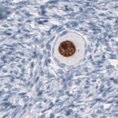 IHC Staining of Oocyte Germinal Cells Using Anti-SALL4 Monoclonal Antibody Immunohistochemical staining of human germinal cells in an oocyte using Anti-SALL4 monoclonal antibody (Product No. AMAb91769) showing nuclear positivity.