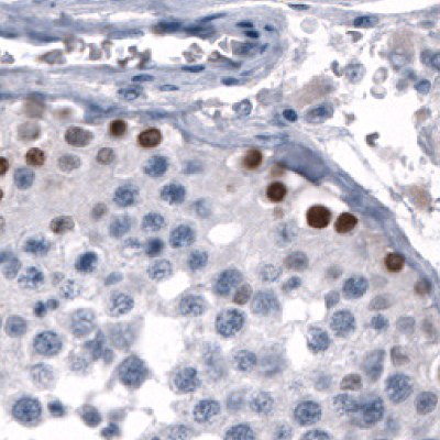 IHC Staining of Testis Germinal Cells Using Anti-SALL4 Monoclonal Antibody Immunohistochemical staining of human germinal cells in testis using Anti-SALL4 monoclonal antibody (Product No. AMAb91769) showing nuclear positivity