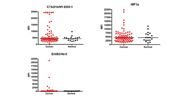 Cancer Autoantibody Analysis Graph showing data for cancer autoantibody analysis. Using MILLIPLEX® Human Cancer Autoantibody Panel Cat. No. HCABMAG-13K, the MFI (Median Fluorescence Intensity) values of the cancer autoantibody biomarkers were determined in cancer (breast, colorectal, ovarian, lung, prostate) (n=78) and healthy control (n=18) serum samples (samples diluted at 1:100).