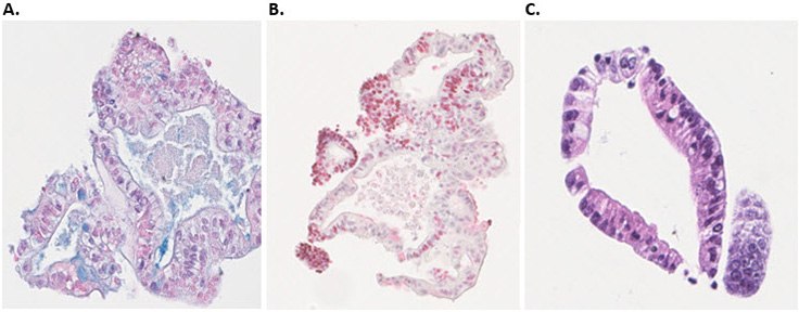 Immunohistochemical (IHC) characterization of human colon organoids. Immunohistochemical (IHC) characterization of human colon organoids. A) Goblet cells identified with alcian blue staining B) proliferating cells identified using Ki67 antibody (red) C) nuclei and plasma protein identified using H&E staining.