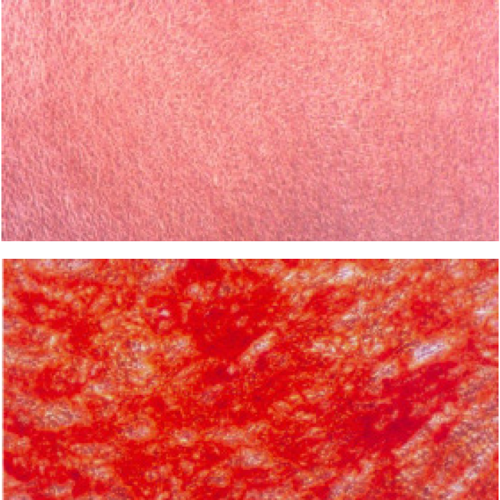Trilineage Differentiation of Multipotent Human Mesenchymal Stem Cells (MSCs) into Osteocytes, Adipocytes and Chondrocytes MSC cells were cultured for 12 days in PromoCell MSC Growth Medium 2 for the negative control (upper panel) or MSC Osteogenic Differentiation Medium for the differentiation sample (lower panel). In contrast with the negative control, the mature osteoblasts differentiated from MSC show intense redorange staining of mineralized bone matrix. Note also the concentration of Alizarin Red S staining in some of the larger bone nodules.