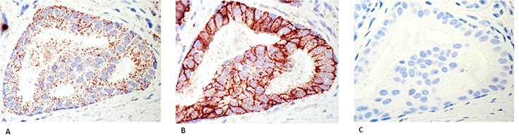 Detection of HER2 receptor and HER2/HER3 heterodimers in FFPE breast cancer tissue using Duolink<sup>®</sup> PLA Brightfield. (A) Duolink<sup>®</sup> PLA was performed using anti-HER2 and anti-HER3 primary antibodies that were optimized to give individual PLA signals, showing HER2/HER3 interaction. (B) Duolink<sup>®</sup> PLA was performed using only an anti-HER2 primary antibody. Abundance of HER2 receptor, which scored 2+ by Pantomics Inc. for HER2 by IHC, caused coalescence of PLA signals. (C) Negative control (no primary antibody). PLA signals are shown as reddish brown dots; the nuclei are blue. Detection of HER2 receptor and HER2/HER3 heterodimers in FFPE breast cancer tissue