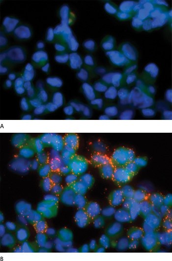 Detection of phosphorylated EGF receptors using Duolink™ <i>In Situ</i> Probemaker. EGFR phosphorylation was detected by in situ PLA (red PLA signals) in A431 cells. A431 cells were either left untreated (A), or stimulated with rhEGF for 2 min (B). Two primary antibodies, one against the EGFR protein and the other against phosphorylated tyrosines, were directly conjugated to unique DNA strands using Duolink™ <i>In Situ</i> Probemaker PLUS and MINUS according to the Duolink™ Probemaker Instructions. The cells were counterstained with anti-actin (green) and DAPI (blue) to visualize the cytoplasm and nucleus, respectively. Detection of phosphorylated EGF receptors using Duolink™ In Situ Probemaker